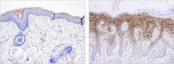 皮膚組織でのC10orf99ペプチドの産生の様子（茶色の色素で染色）。健康な皮膚では目立たない（左）。アトピー性皮膚炎の皮膚では、体表に近い部分でC10orf99ペプチドが大量に産生される（右）。