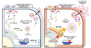 CDC42-C末端異常症における炎症病態を解明―ゴルジ体への異常蓄積がパイリンインフラマソーム形成を過剰促進―