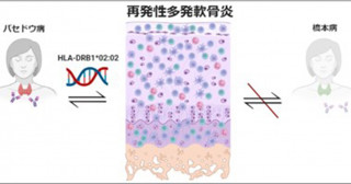 再発性多発軟骨炎はバセドウ病を合併しやすい－統計学的解析から特定の病変・遺伝子型との関係を解明－