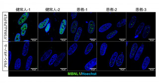 患者由来iPS細胞を用いた筋強直性ジストロフィー骨格筋病態の再現と薬効評価のための定量的な細胞評価系の確立