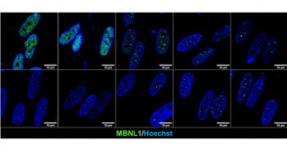 Reproducing skeletal muscle pathology of myotonic dystrophy using patient-derived iPS cells and establishing a new system to quantitatively evaluate drug efficacy