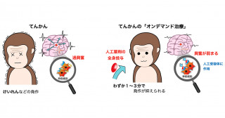 「てんかん」の発生を時間的・空間的にピンポイントで抑える画期的な治療法を開発-世界で初めてサルでの有効性を実証、臨床応用に向け大きく前進-