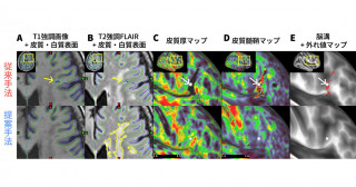 ありふれた脳の白質病変がMRI画像解析を悪化させていた―従来手法に機械学習を組み入れた改善手法の開発―