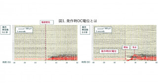 難治てんかん焦点の新しいバイオマーカー「発作時DC電位」 世界で初めて時定数2秒でも有用であることを明らかに