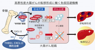 大腸がん：骨髄が転移を促進？―新しい治療法への展望―