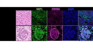 乳がんの再発を起こす原因細胞を解明