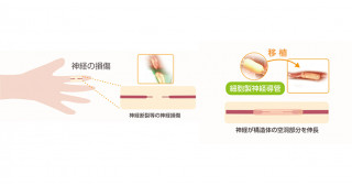 世界初の末梢神経損傷に対する三次元神経導管移植―医師主導治験結果と社会実装化に向けて―