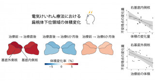 うつ病治療における扁桃体の体積と不安改善 電気けいれん療法に特異的な治療機序の解明につながる成果